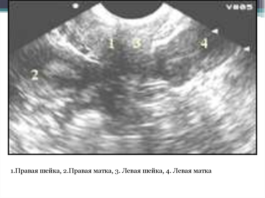 Левая матка. УЗИ при двурогой матке. Беременность двойней при двурогой матке. Двойня в двурогой матки УЗИ.