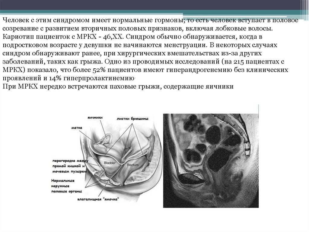 Синдром рокитанского кюстнера майера хаузера