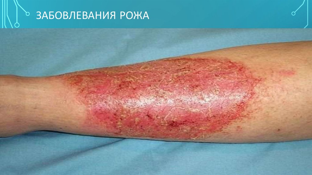 Забовлевания рожа