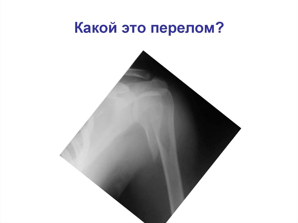 Какой это перелом?
