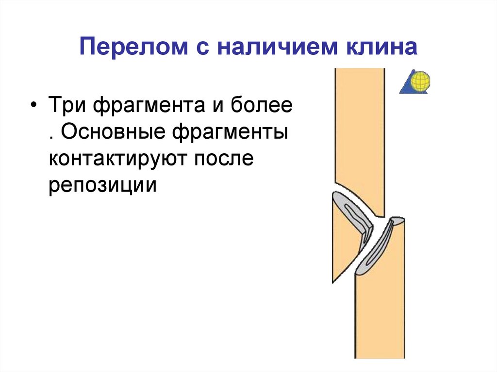 Перелом с наличием клина