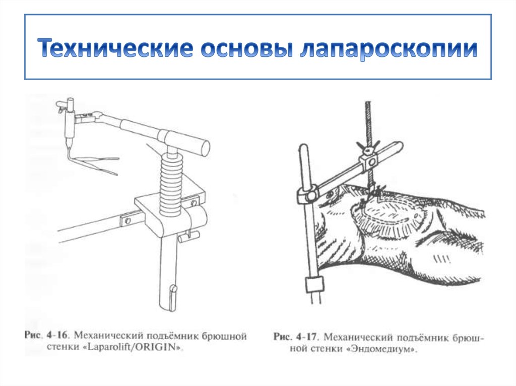 Техническая основа. Источник света лапароскопия. Лапароскопия преимущества и недостатки. Допустимый вес для лапароскопии.