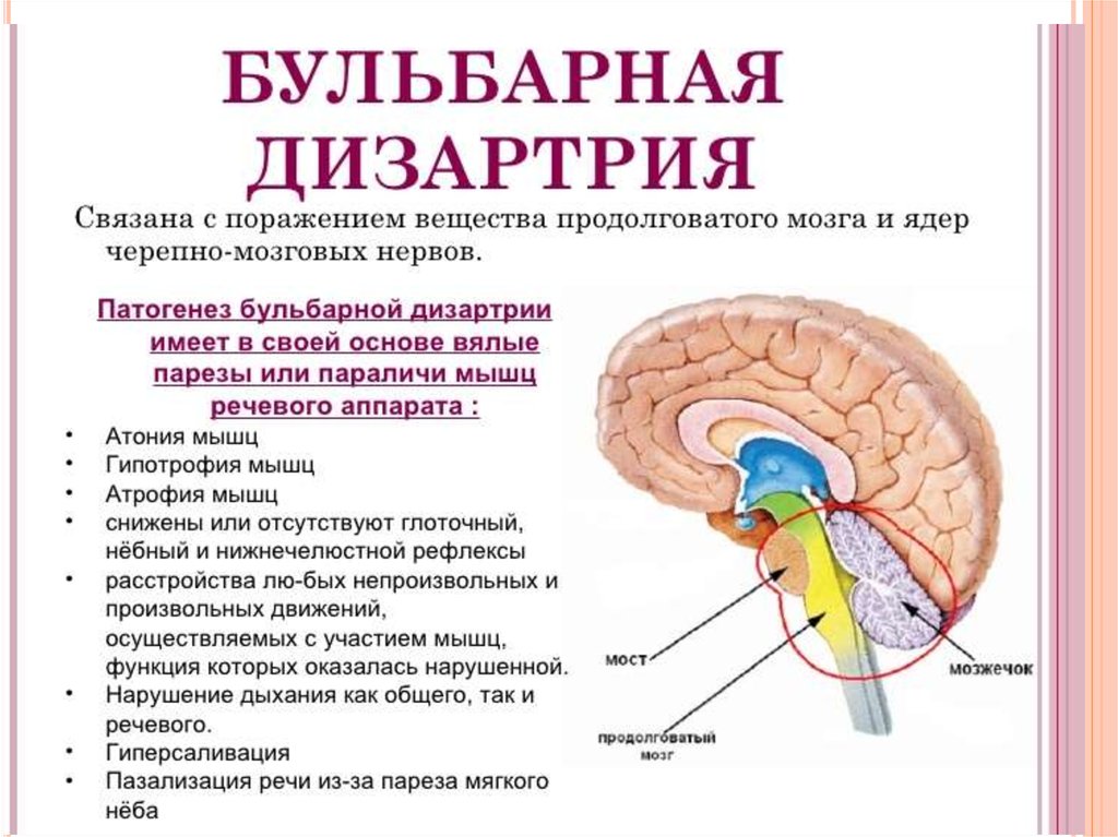 Дизартрия на резидуальном перинатальном фоне