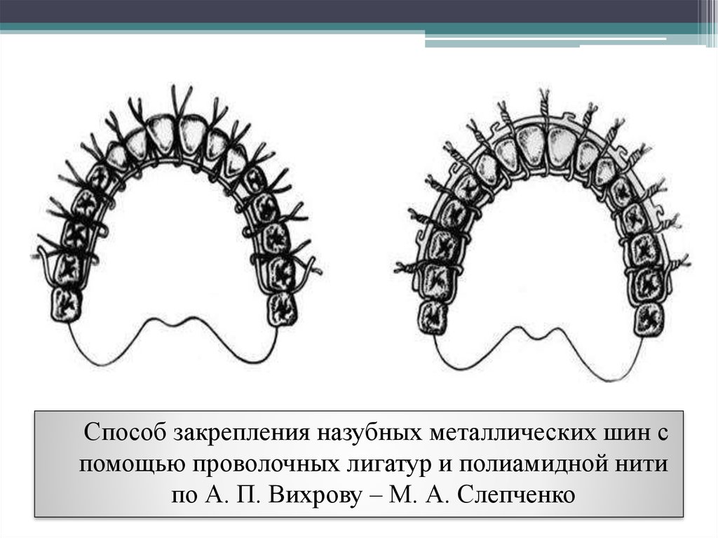 Одностороннее шинирование челюсти фото