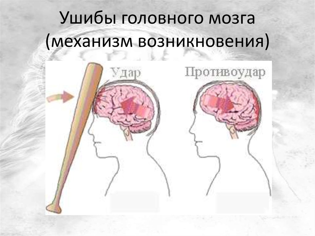 Лечение травм мозга. Механизмы ушиба головного мозга. Основные симптомы ушиба головного мозга. Тяжелый ушиб головного мозга.