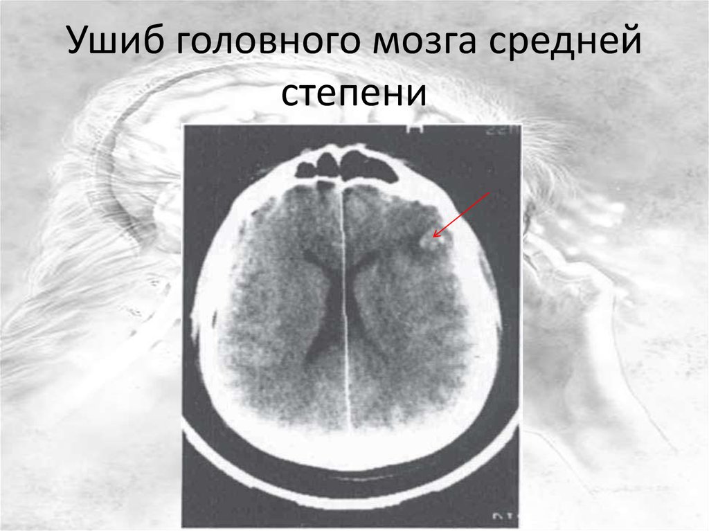 Ушиб головного мозга картинки