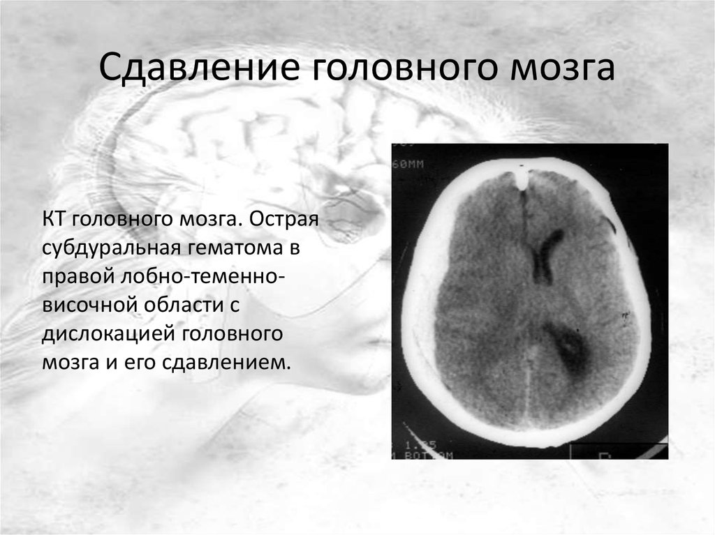 Сдавление головного мозга картинки