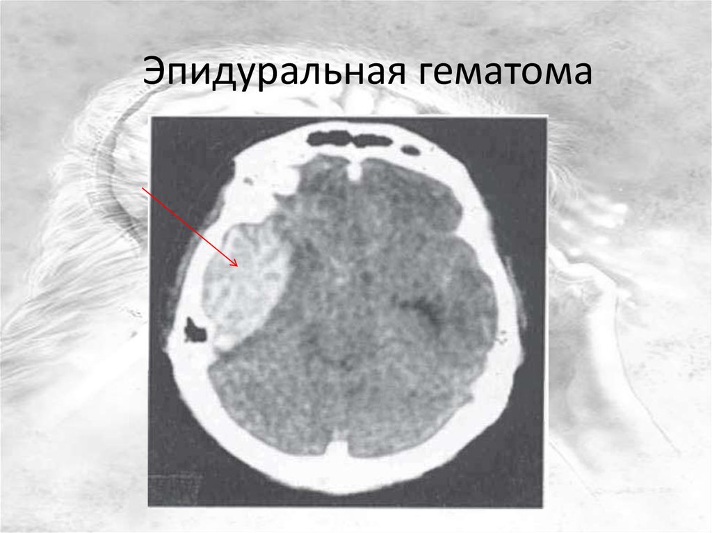 Эпидуральная гематома на кт