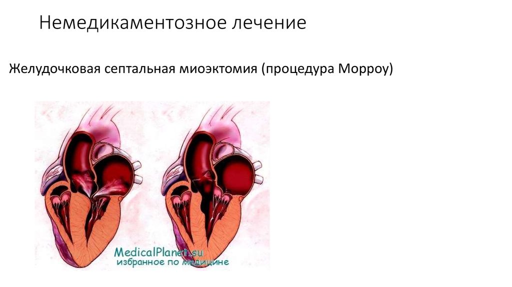 Миоэктомия. Чрезаортальная септальная миэктомия. Септальная миоэктомия сердца. Хирургическая септальная миоэктомия.