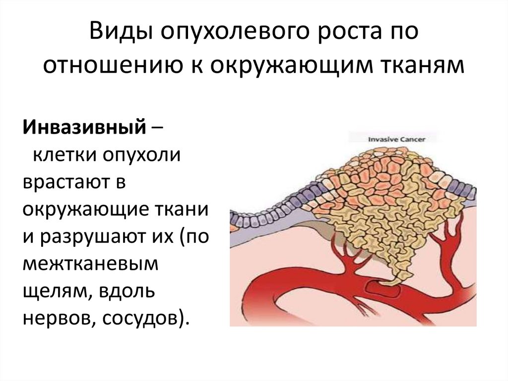 Виды опухолевого роста схема