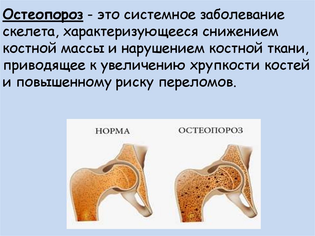 Лечение костных заболеваний