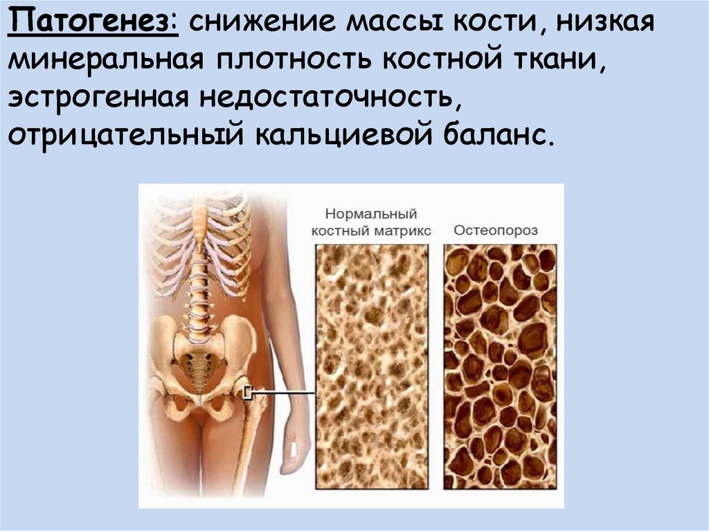 Плотный увеличиваться. МПКТ остеопороз. Низкая минеральная плотность костной ткани. Остеопороз костей. Патогенез остеопороза.