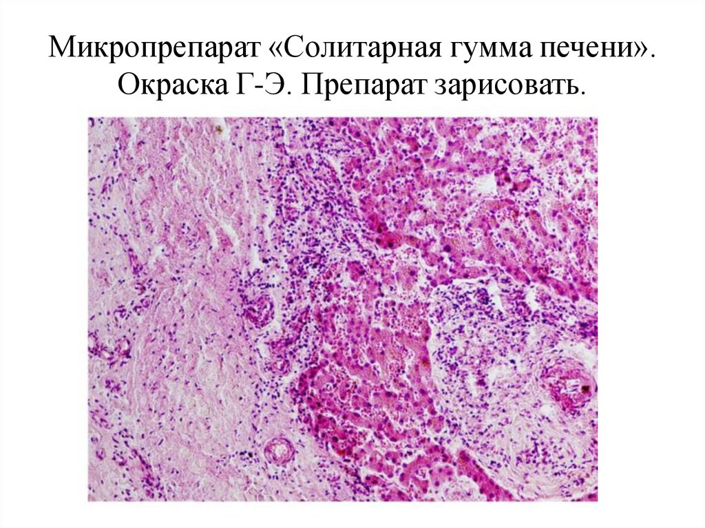 Сифилитическая гранулема