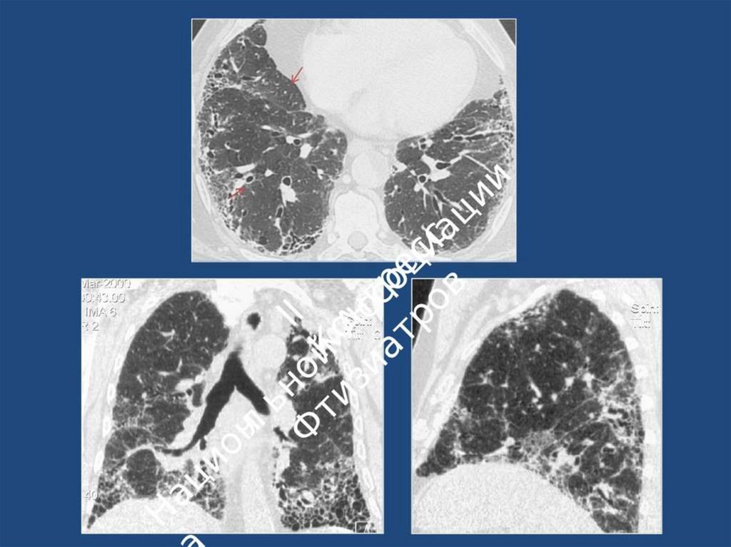 Идиопатический легочный фиброз тесты. Идиопатический легочный фиброз кт. Интерстициальный фиброз легких кт. Интерстициальный отек кт. Идиопатический легочный фиброз аускультация.