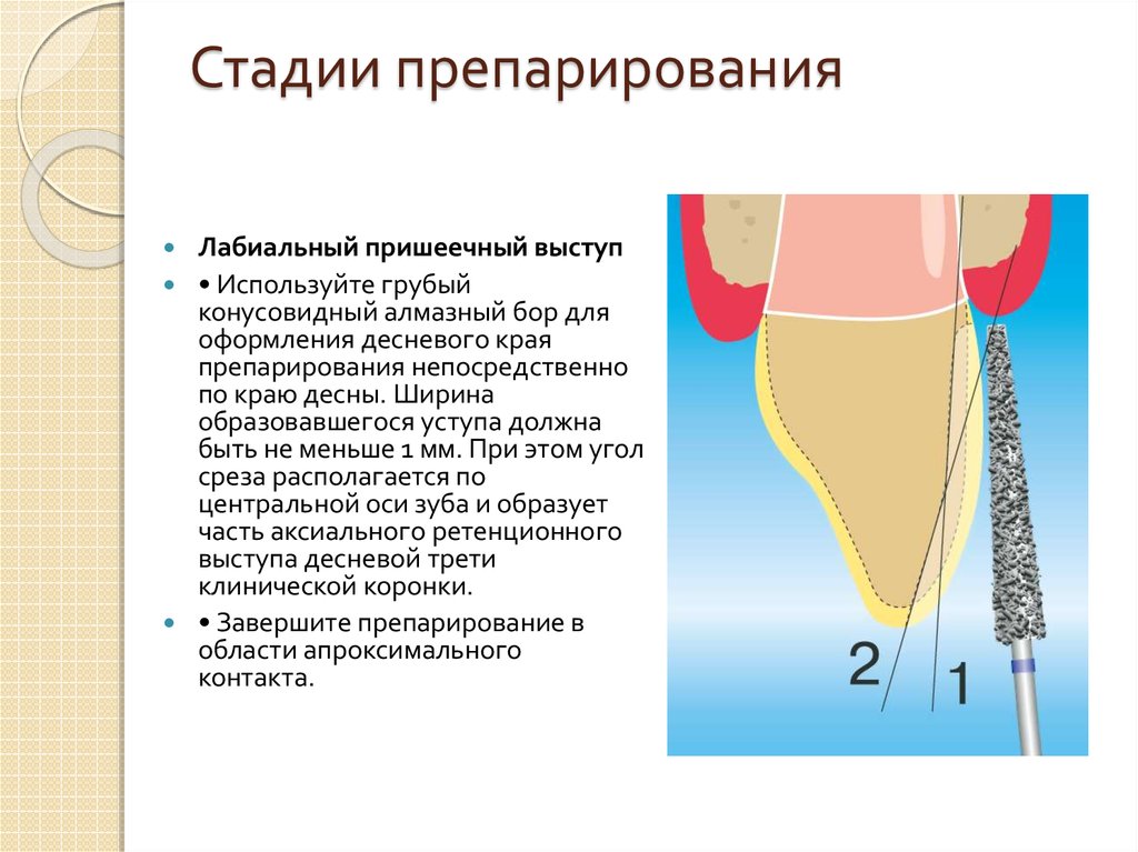Стадии препарирования