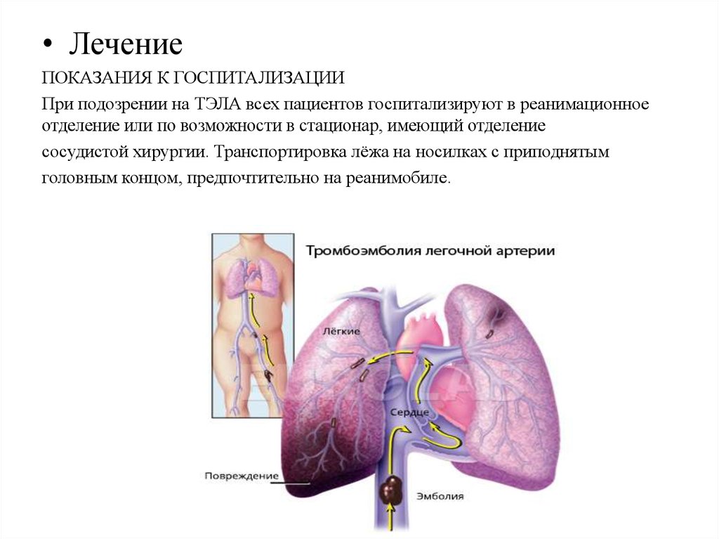 Тромбоэмболия легочной артерии прогноз