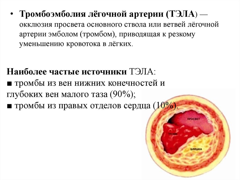 Тромбоэмболия легочных артерий тест