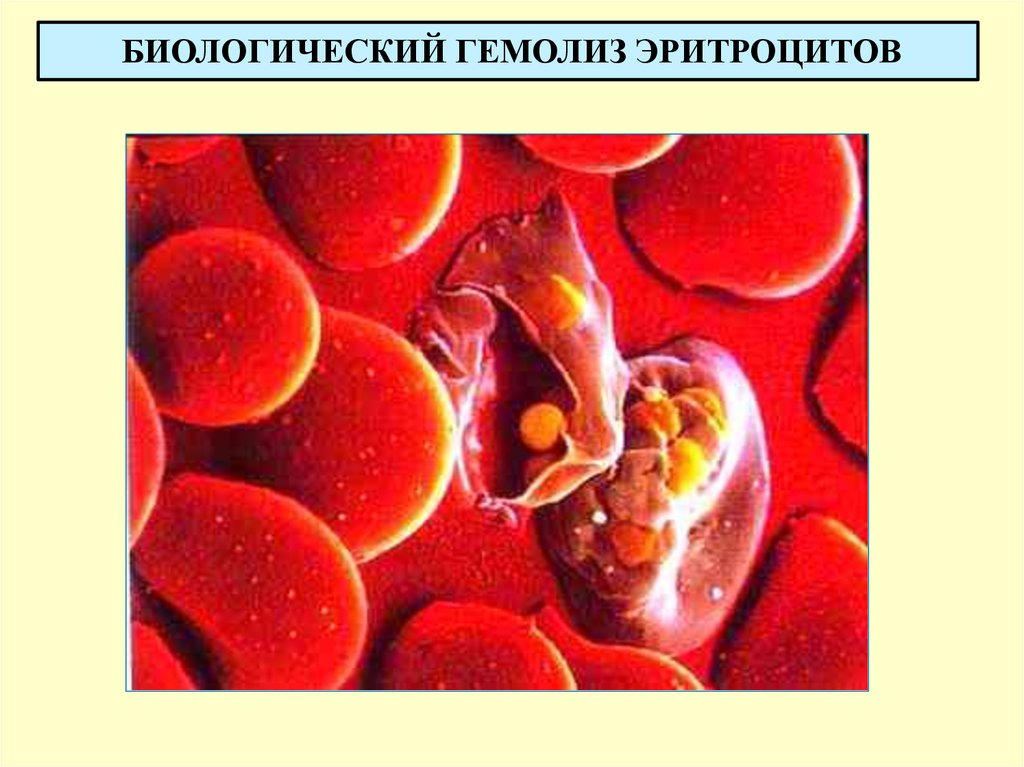 Гемолиз эритроцитов. Биологический гемолиз эритроцитов. Гемолиз разрушение эритроцитов. Гемолиз сыворотки. На что распадается эритроцит.