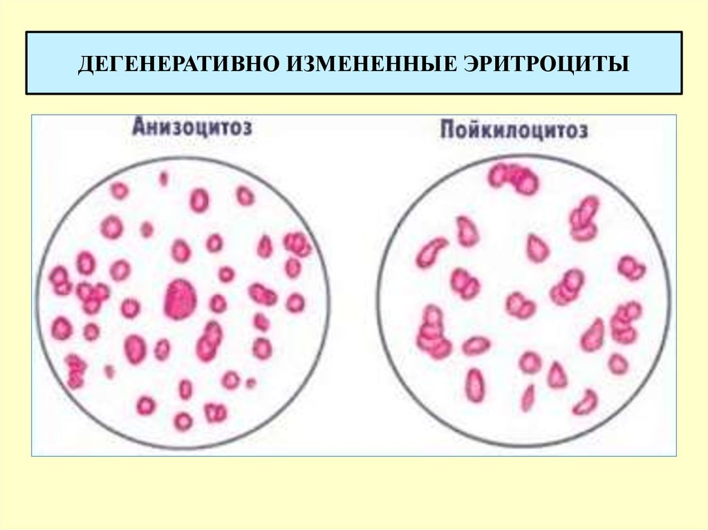 Анизоцитоз эритроцитов. Анизоцитоз пойкилоцитоз анизохромия. Анизоцитоз и пойкилоцитоз при анемии. Анизоцитоз и пойкилоцитоз крови. Анизо и пойкилоцитоз при анемии.