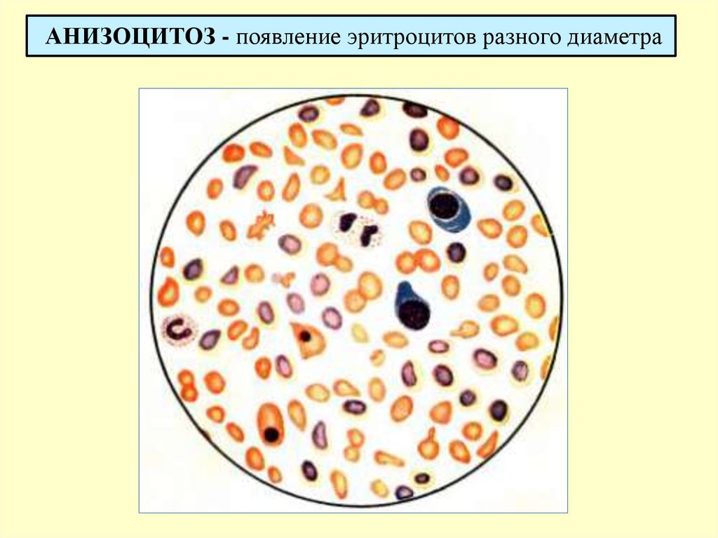 Анизоцитоз эритроцитов. Физиологический анизоцитоз. Анизоцитоз клеток. Макроцитарный анизоцитоз.