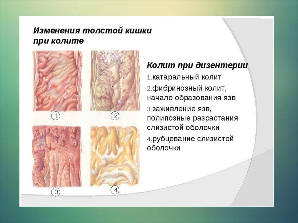 Патогенез дизентерии схема