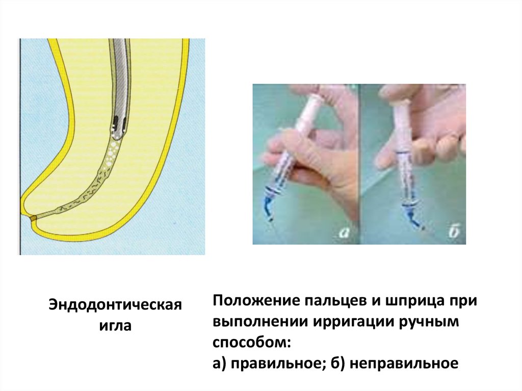 Ирригация корневых каналов презентация