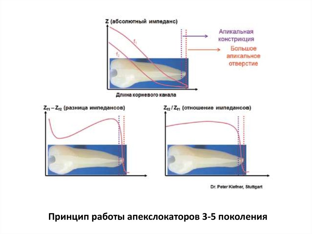 Трети корневого канала. Тактильный способ определения длины корневого канала. Апикальная констрикция. Апикальной констрикции корневой канал. Как создать апикальное отверстие при обработке корневого канала.
