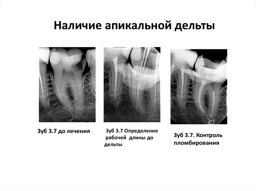 Методы лечения зубов с проблемными корневыми каналами презентация