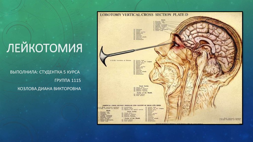 Лоботомия для чего. Лимбическая лейкотомия. Трансорбитальная Лоботомия. Лоботомия через глазницу.