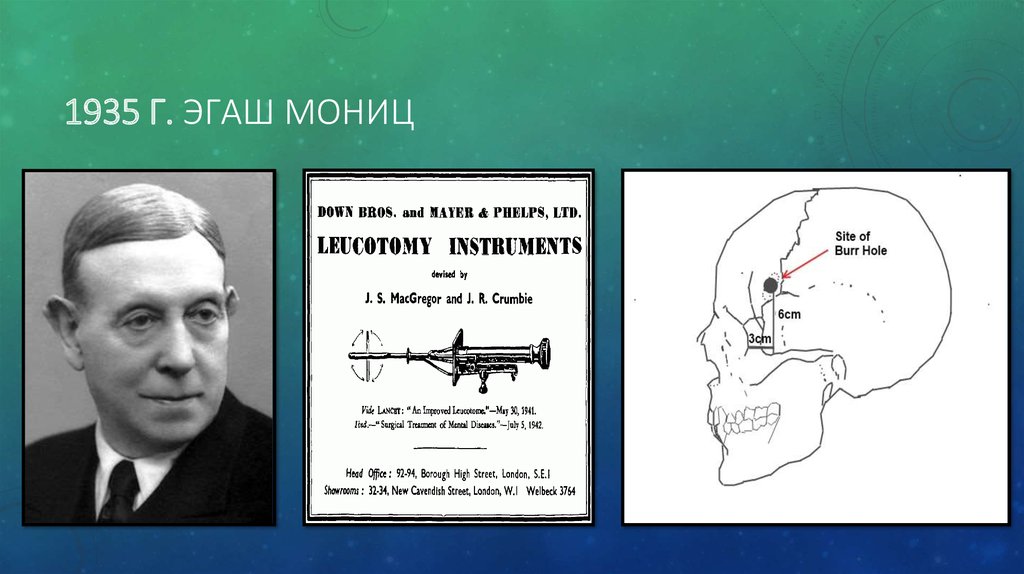 1935 г. Эгаш Мониц