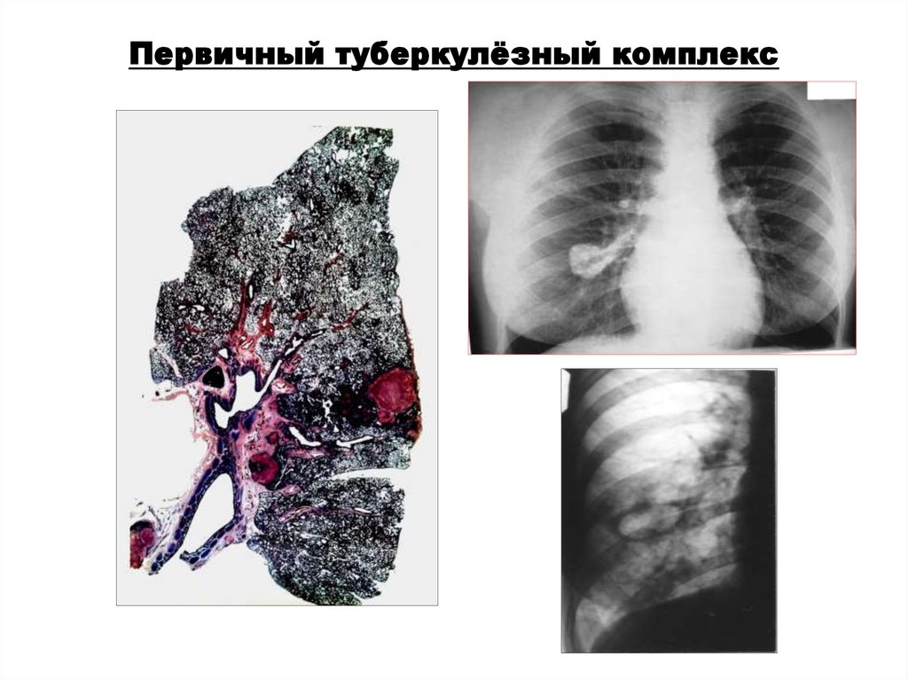 Врожденный туберкулез. Первичный туберкулезный комплекс фтизиатрия. Первичный туберкулезный комплекс рентген фаза инфильтрации. Пневмоническая фаза первичного туберкулезного комплекса.