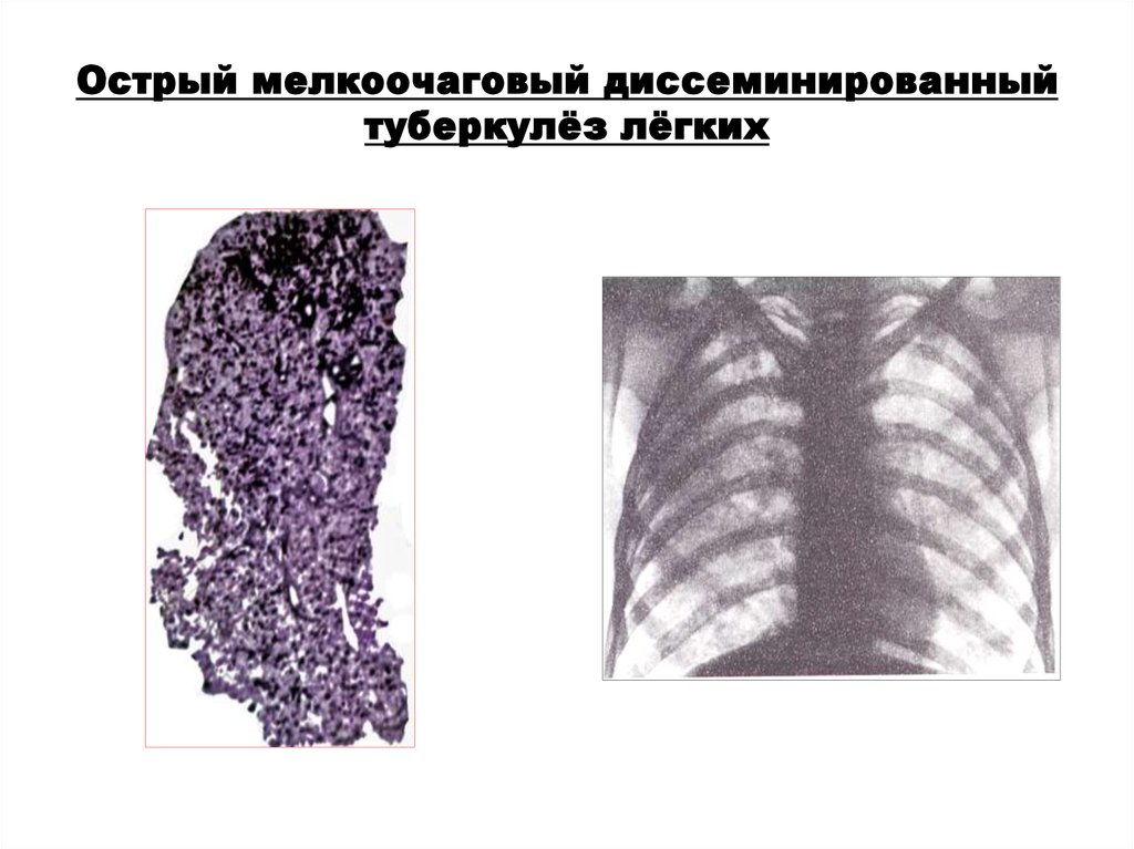 Острый диссеминированный туберкулез. Диссеминированный туберкулез патологическая анатомия. Острый диссеминированный туберкулез легких рентген. Острый милиарный диссеминированный туберкулез. Подострый диссиминированный туберкулёз рентген.