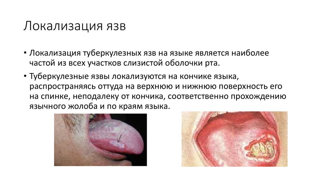 Локализация язв