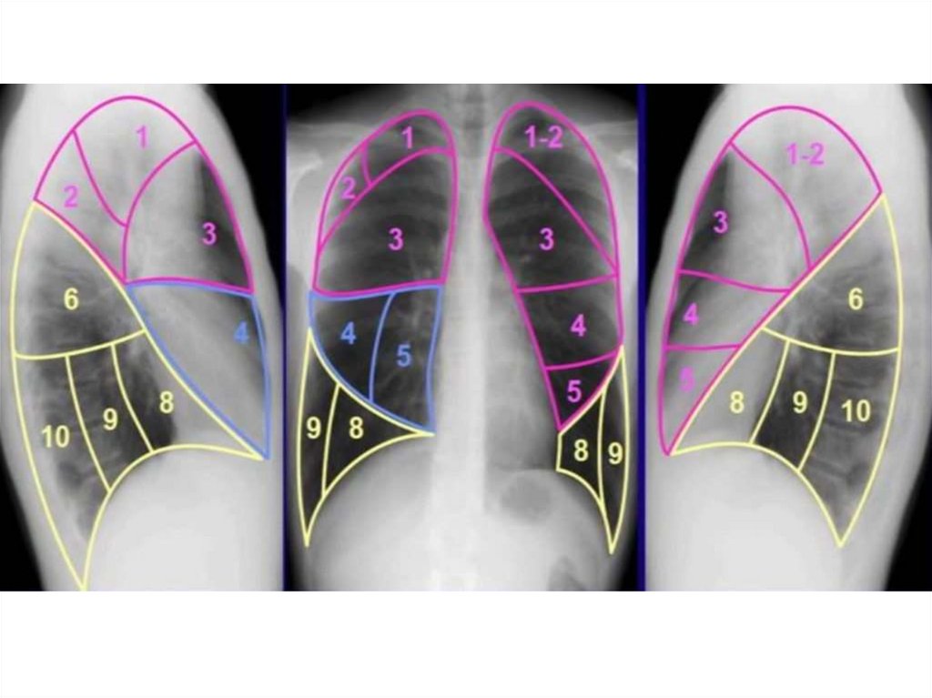 Схема сегментов легких на рентгене