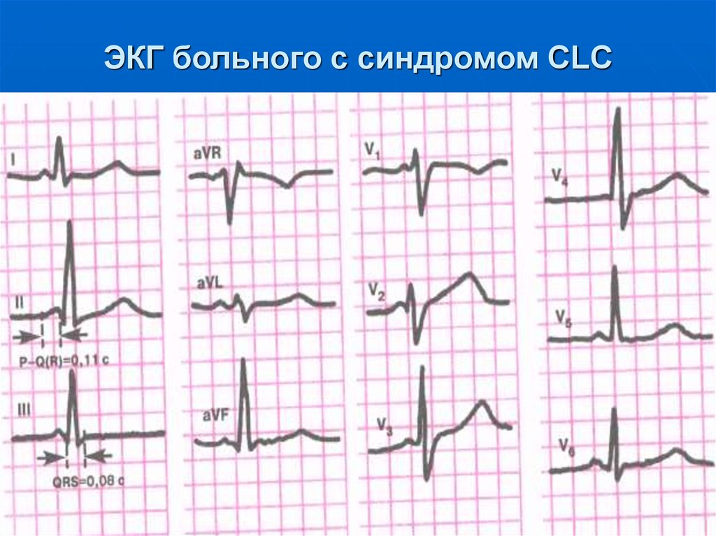 Экг синдромы