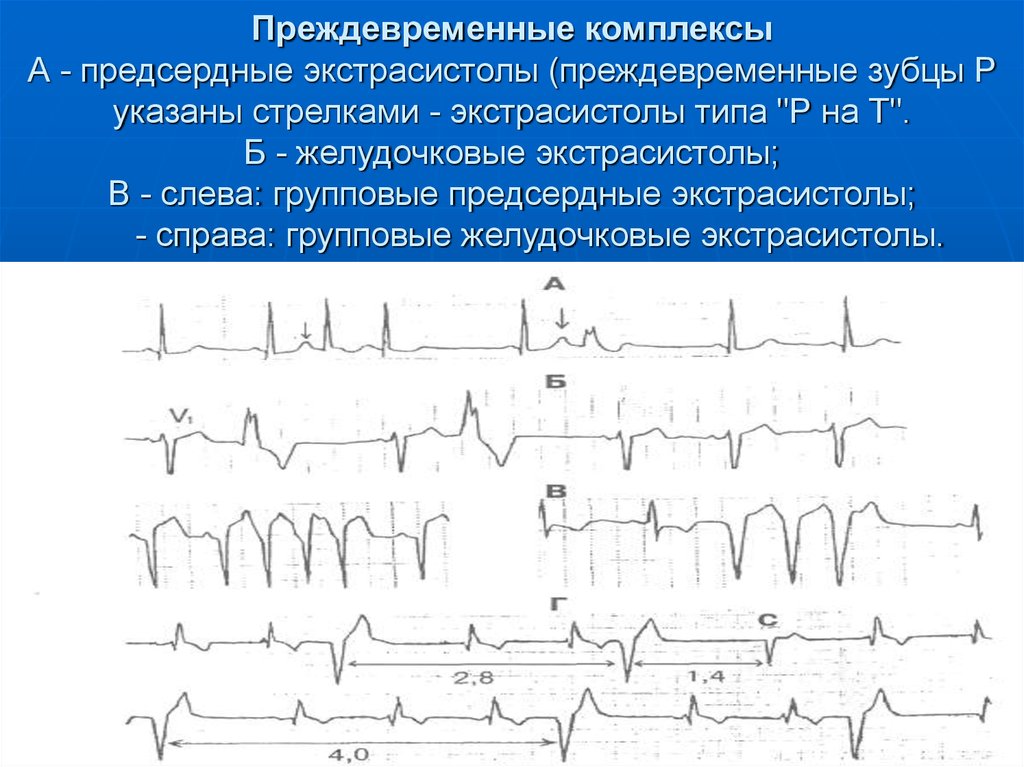 Предсердные экстрасистолы