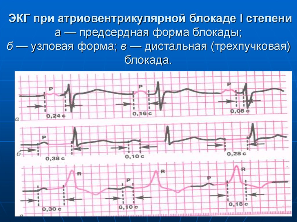 Блокада сердца что это простыми словами