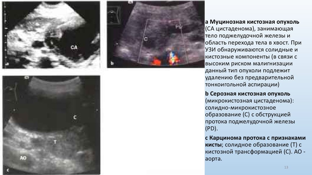 Эхографическую картину кисты поджелудочной железы необходимо дифференцировать с