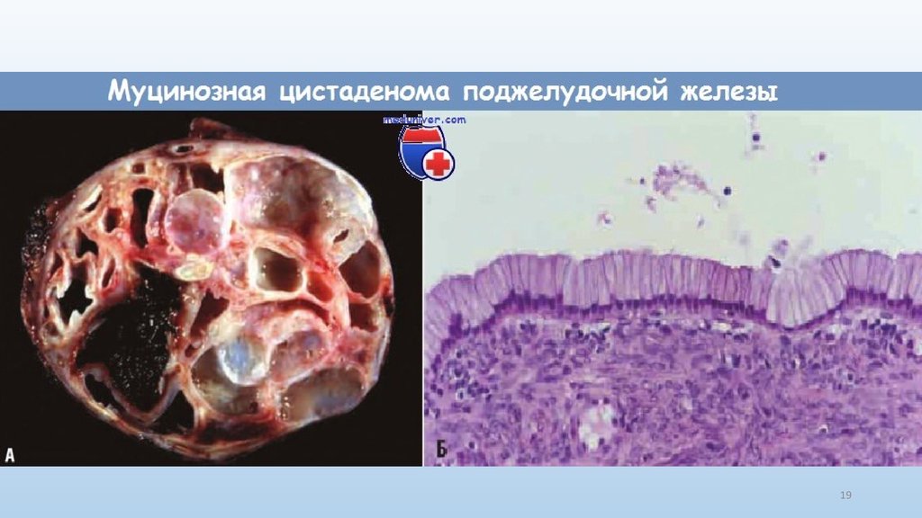 Нейроэндокринные опухоли общие принципы диагностики и лечения руководство