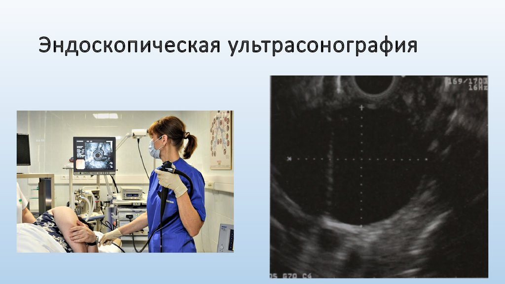 Эндоузи. Эндоскопическая ультрасонография желчного пузыря. Эндоскопическая ультрасонография желчных протоков. Эндоскопическая ультрасонография пищевода. Эндоскопическая ультрасонография хронический панкреатит.