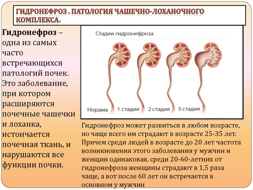 Почки стадии