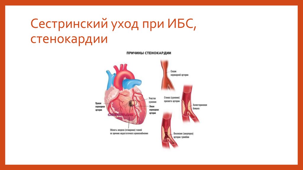 Сестринский уход при заболеваниях сердечно сосудистой системы презентация