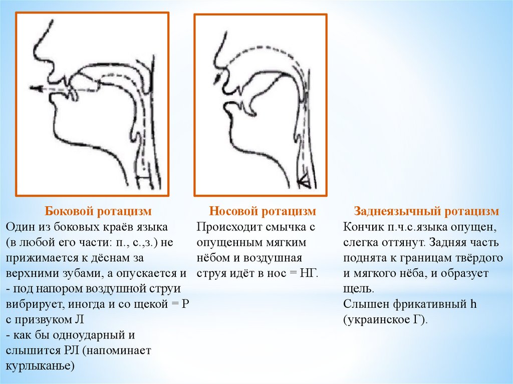 Виды ротацизма