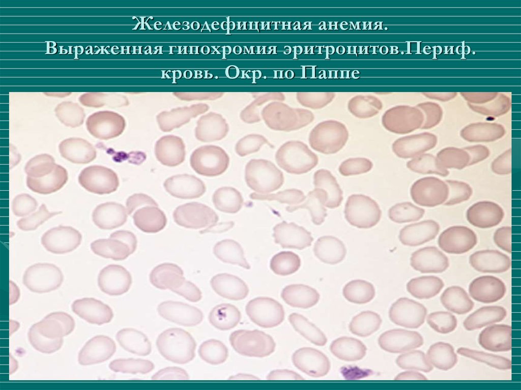 Гипохромия железодефицитная анемия. Гипохромия микроцитоз. Гипохромия и гиперхромия. Гипер хром гипо хром анемия. Микроцитарная гипохромная анемия микроскоп.