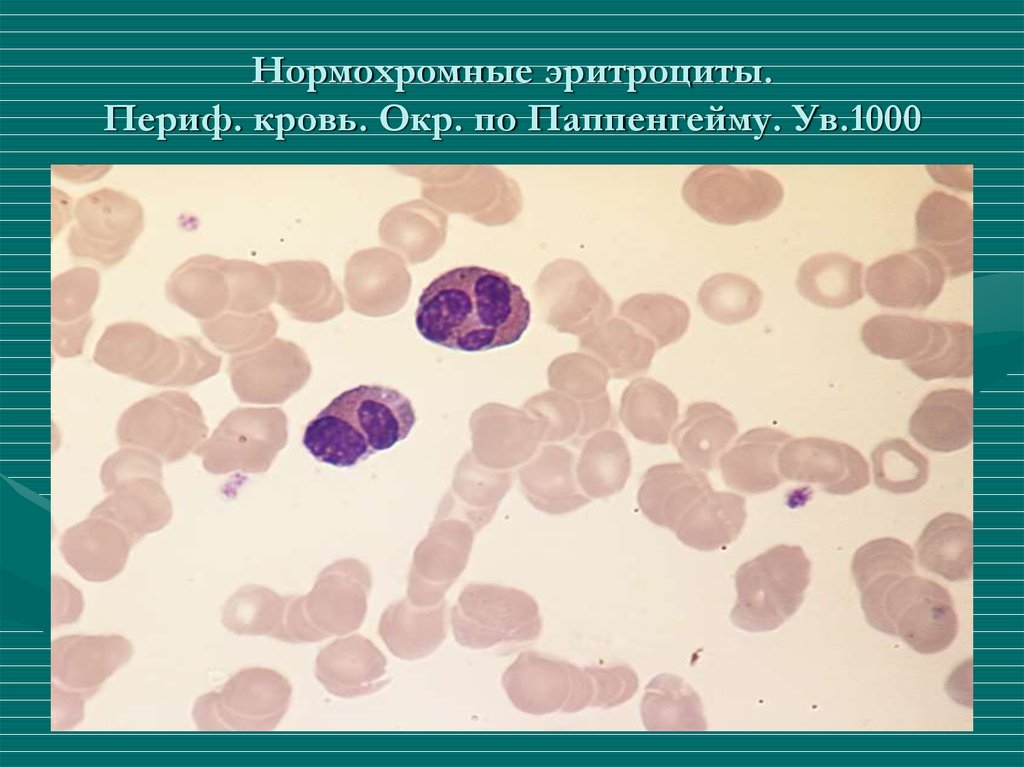 Гипохромия железодефицитная анемия. Нормоцитарная анемия фото.