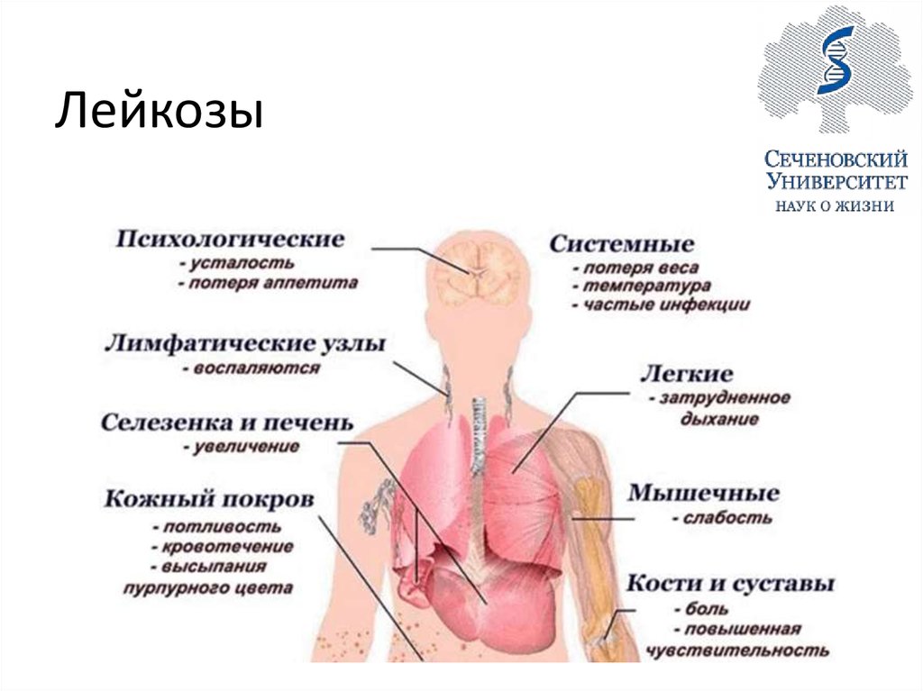 Клиническая картина острых лейкозов