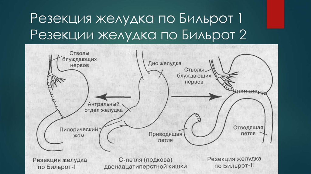 Резекция желудка картинки