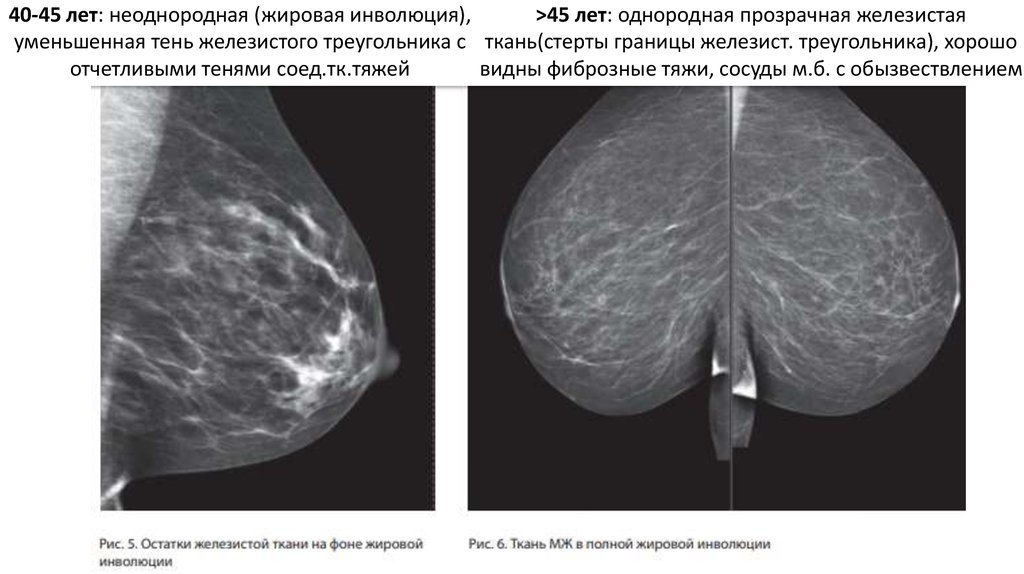 Жировая инволюция молочных желез. Маммография нормальные показатели. Норма молочной железы маммограмма. Маммография железистая ткань. Железистая ткань молочной железы на маммографии.