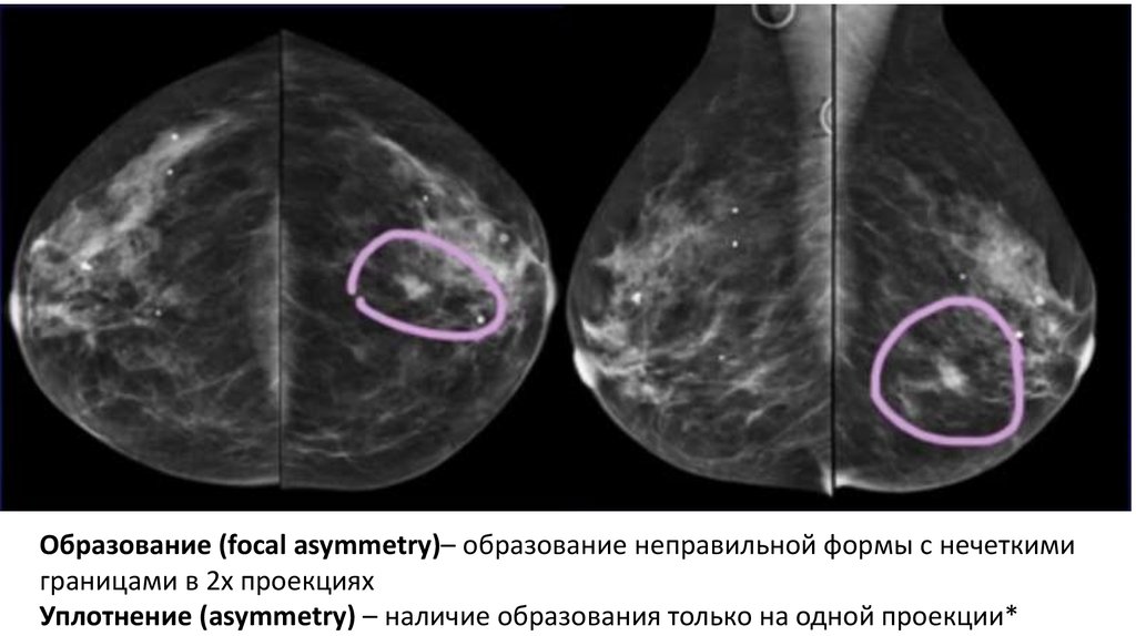 Маммография на какой день. Проекции молочных желез на маммографии. Маммография в двух проекциях что это такое. Косая проекция молочной железы. Маммография двух молочных желез (2 проекции).