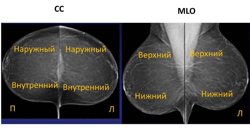 Сроки маммографии